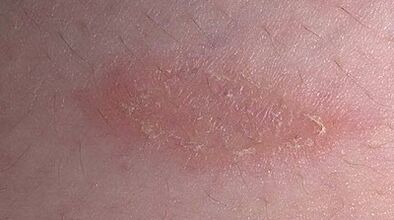 come e con cosa trattare la psoriasi