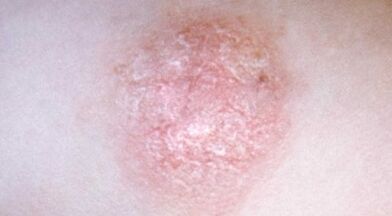 come riconoscere la psoriasi in una fase precoce