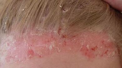 fasi di sviluppo e sintomi della psoriasi