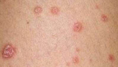 foto della psoriasi nella fase iniziale