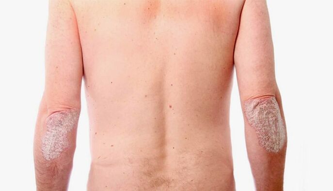 rimedi popolari per il trattamento della psoriasi
