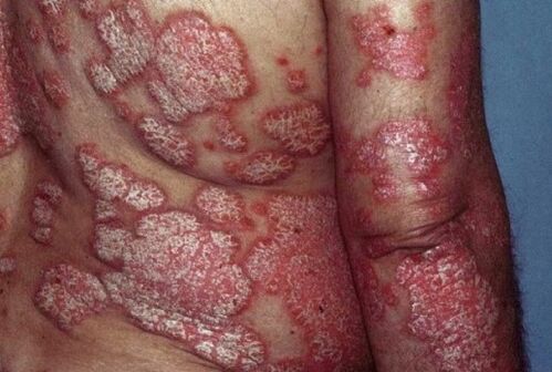 Psoriasi