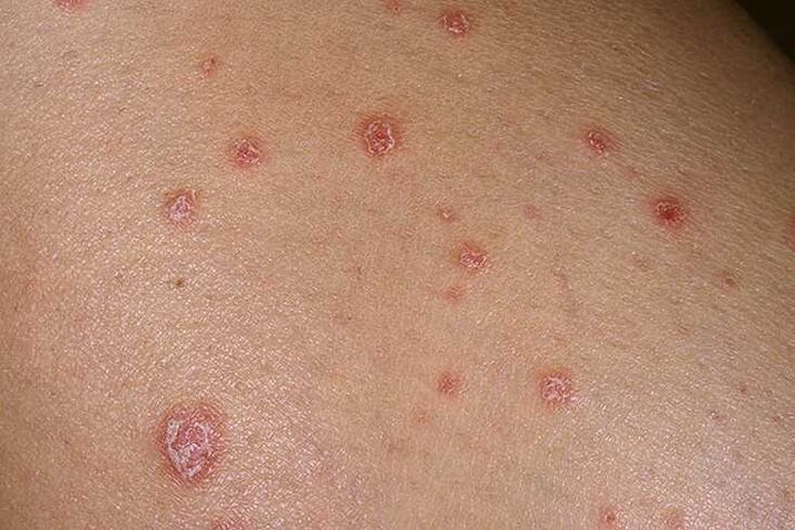 Le cause della psoriasi