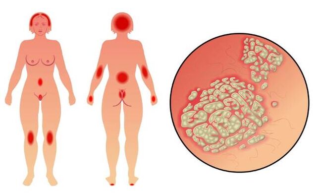 Sintomi della psoriasi