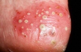 La psoriasi è pustolosa