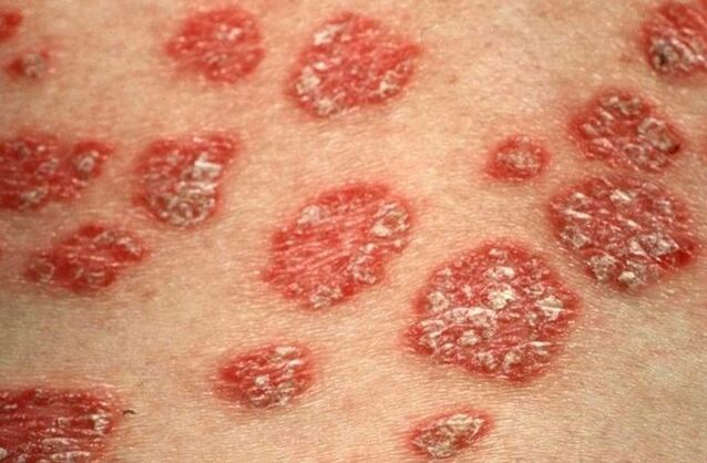 Papule psoriatiche