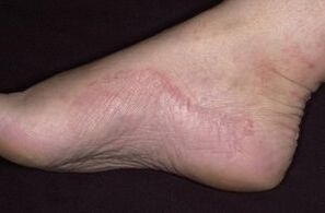 Psoriasi del piede