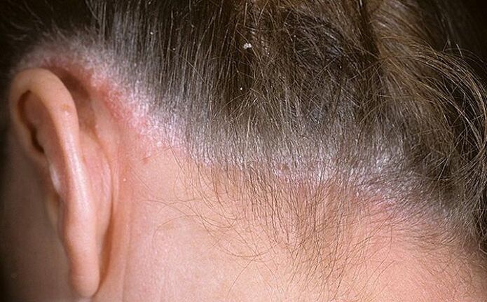Psoriasi tra i capelli