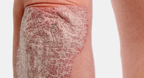 psoriasi