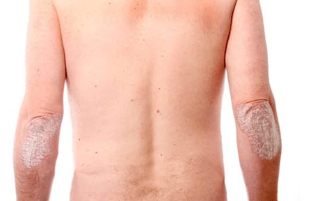 Sintomi generali della psoriasi