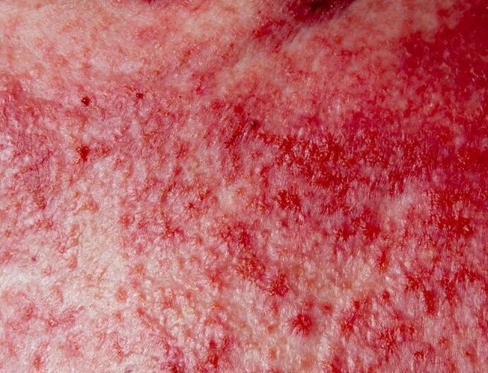 Forma avanzata di psoriasi
