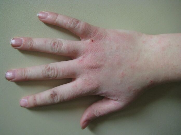 Psoriasi in fase iniziale
