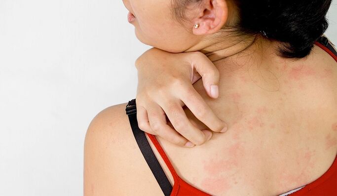 Psoriasi sulla schiena