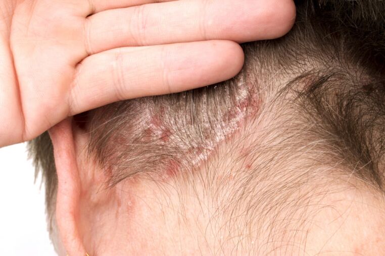 Esacerbazione della psoriasi sulla testa