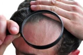 Psoriasi sulla testa attraverso una lente d'ingrandimento