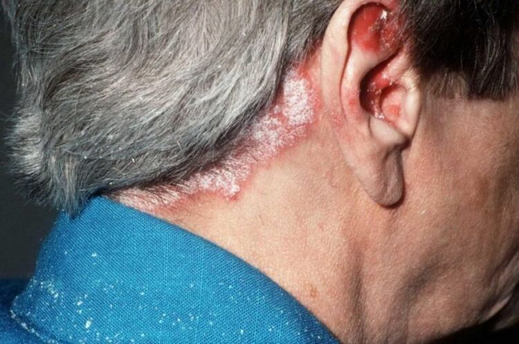 Psoriasi sulla testa