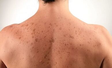 ragioni per lo sviluppo della psoriasi