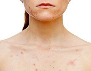 In quali parti del corpo compare la psoriasi