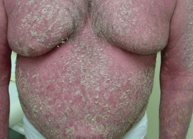 Eritroderma psoriasico sul corpo