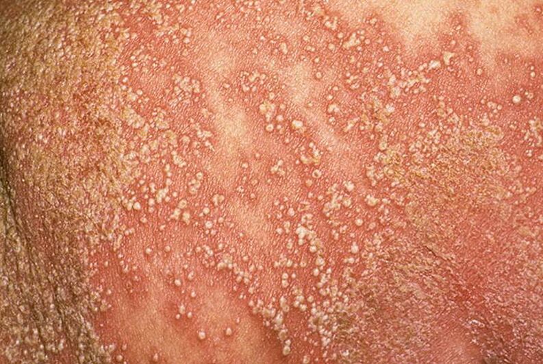 Psoriasi pustolosa