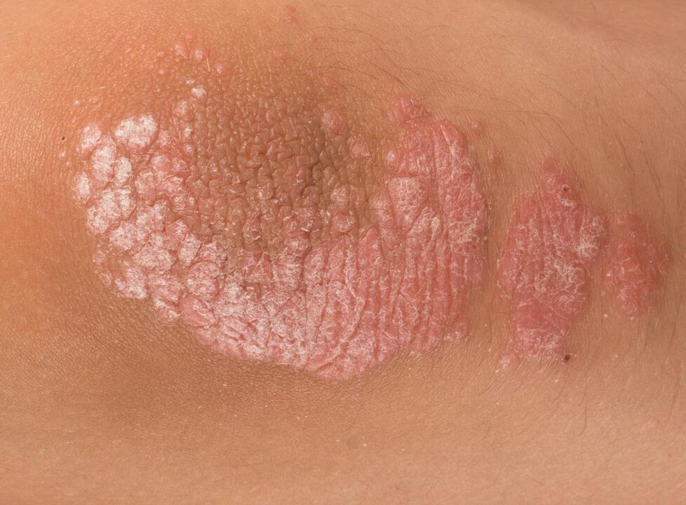 Psoriasi