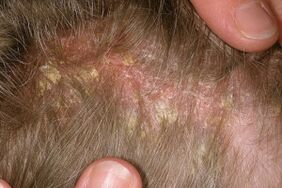Psoriasi sulla testa
